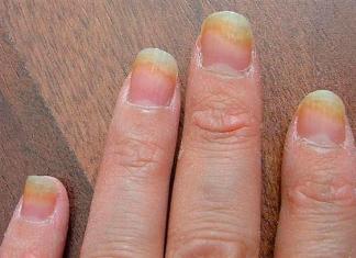 Онихолизис — слоение ногтей вылечат народные средства